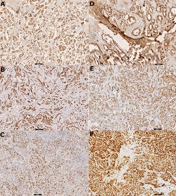 Intertumoral Heterogeneity of Primary Breast Tumors and Synchronous Axillary Lymph Node Metastases Reflected in IHC-Assessed Expression of Routine and Nonstandard Biomarkers